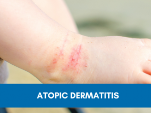 Eczema (Atopic Dermatitis)